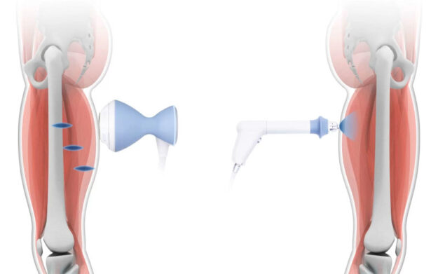 SHOCKWAVE THERAPY SHOCKWAVE THERAPY Progress Physiotherapy in Kingston Ontario, Canada