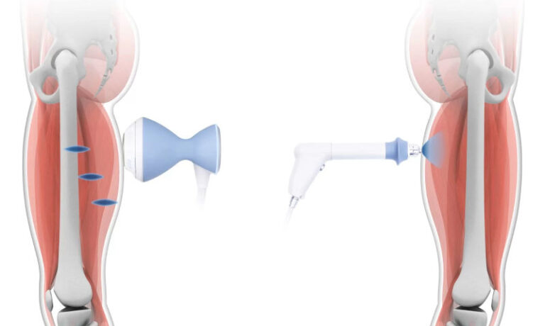 SHOCKWAVE THERAPY SHOCKWAVE THERAPY Progress Physiotherapy in Kingston Ontario, Canada