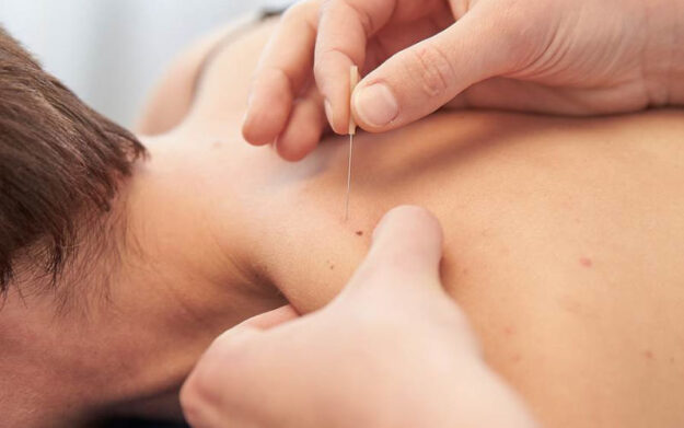 Understanding Dry Needling Physiotherapist applying dry needling to a patient’s upper back during treatment.