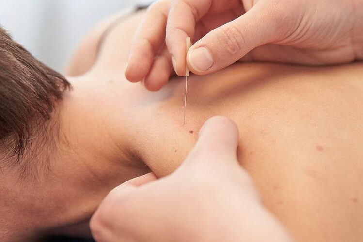 Physiotherapist applying dry needling to a patient’s upper back during treatment.