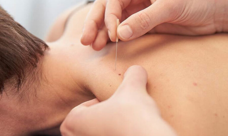 Understanding Dry Needling Physiotherapist applying dry needling to a patient’s upper back during treatment.